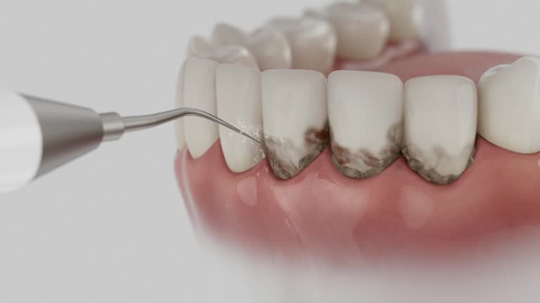 Reliable Wisdom Tooth Removal contractor in Robstown, TX by Smile Center Dentistry